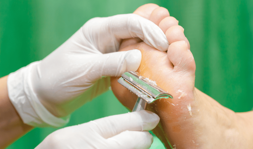 CALLUS REMOVAL